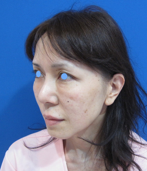 目の下のたるみ、目のくまでお悩みの方、切らずに完璧に解決します。TCB-R法　手術直後　症例写真
